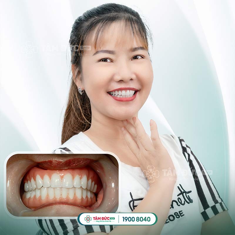 chữa đau tuỷ răng tại nha khoa Tâm Đức Smile