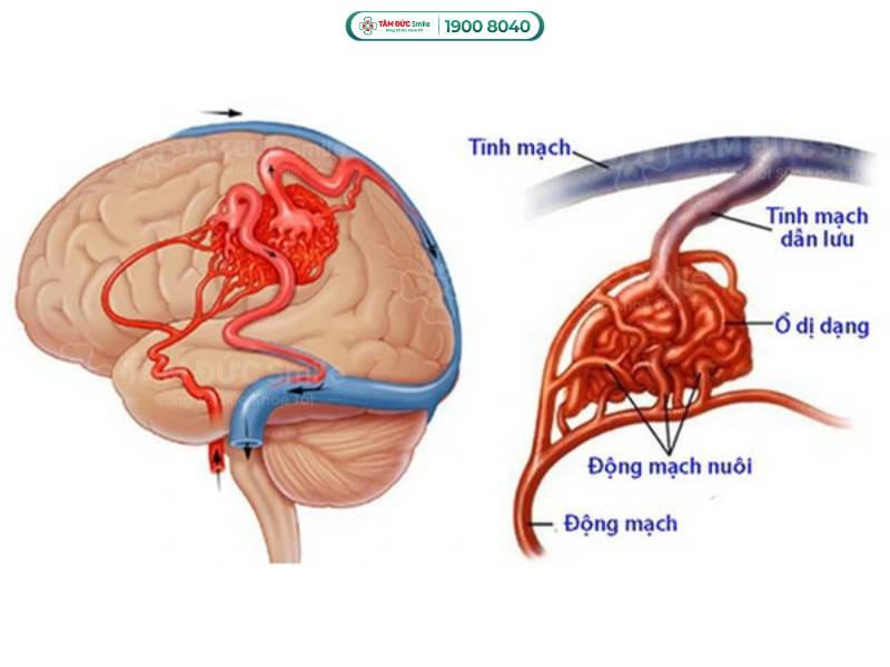 dị dạng mạch máu là gì