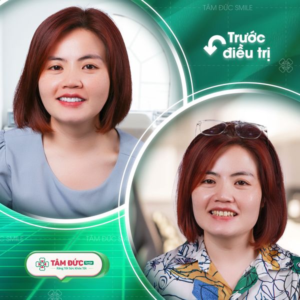 khách hàng bọc răng sứ tại nha khoa Tâm Đức Smile