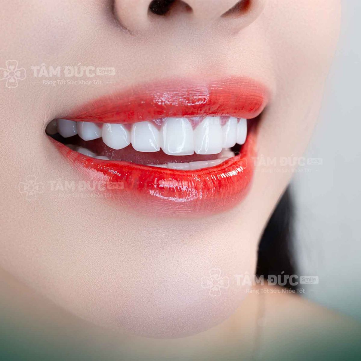 khách hàng bọc răng sứ tại nha khoa tâm đức smile