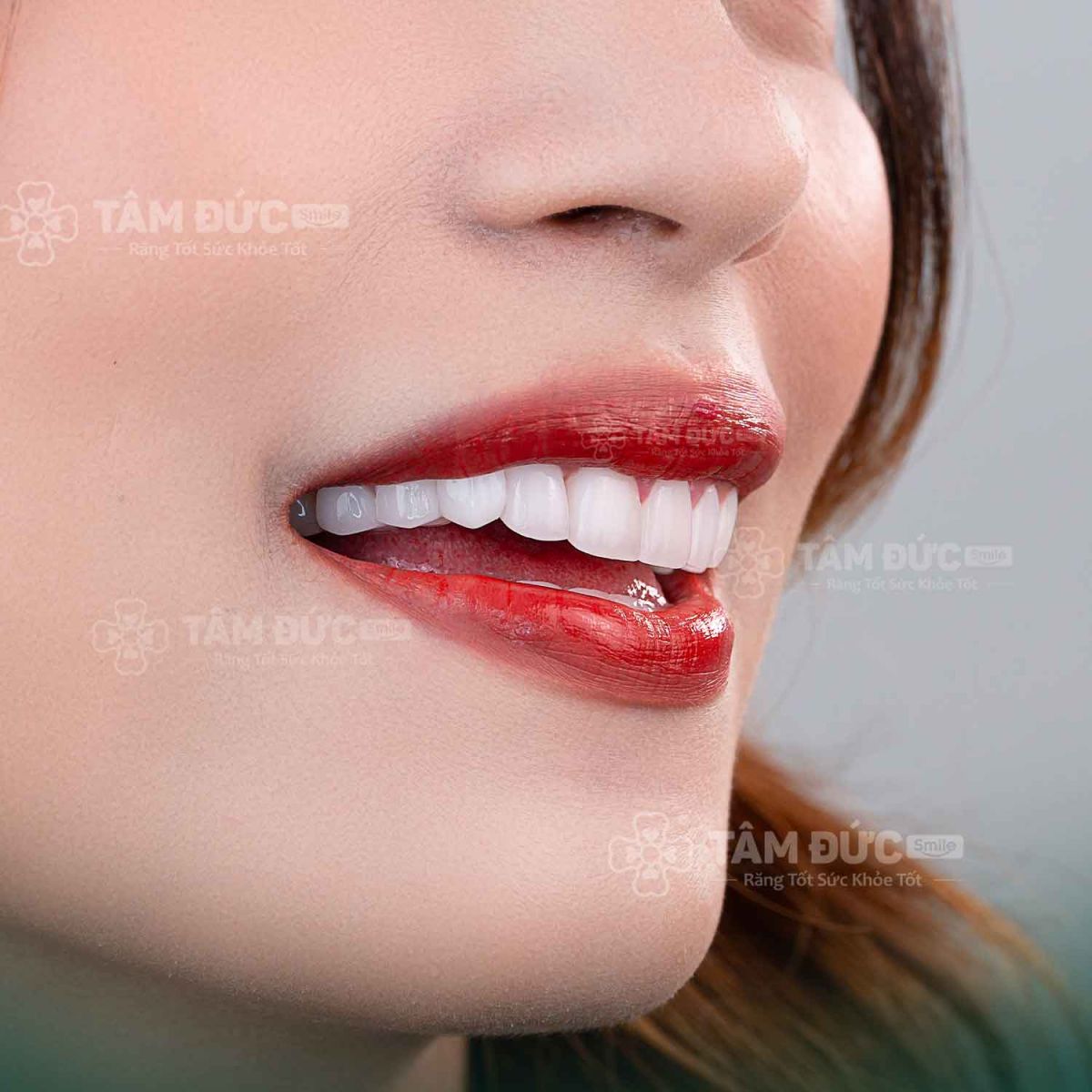 khách hàng bọc răng sứ tại nha khoa tâm đức smile