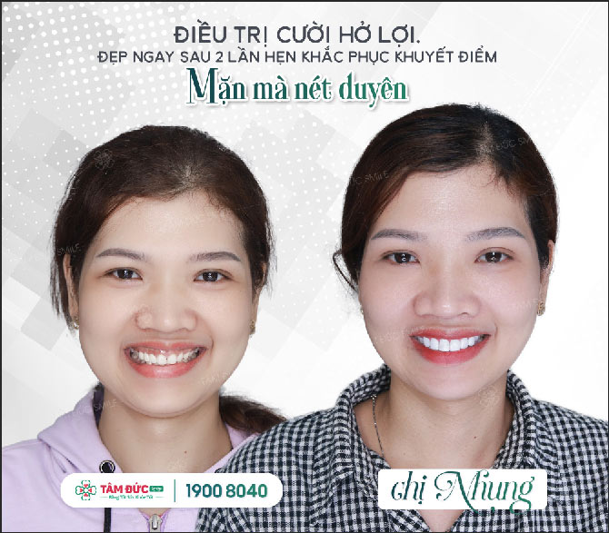 chị Nhung cắt nạo chóp răng tại nha khoa Tâm Đức Smile