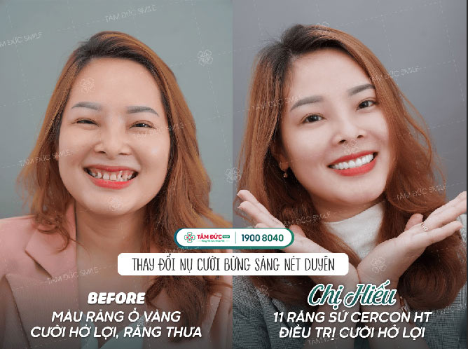 chị Hiếu cắt nạo chóp răng tại nha khoa Tâm Đức Smile