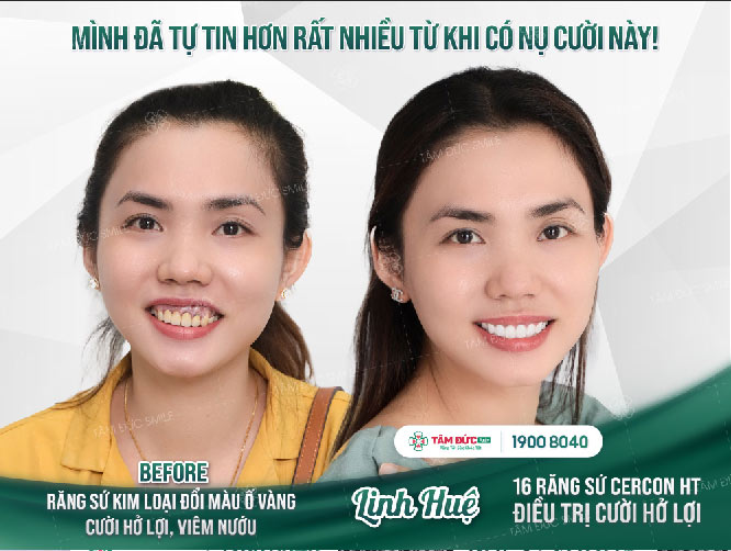 chị Huệ cắt nạo chóp răng tại nha khoa Tâm Đức Smile