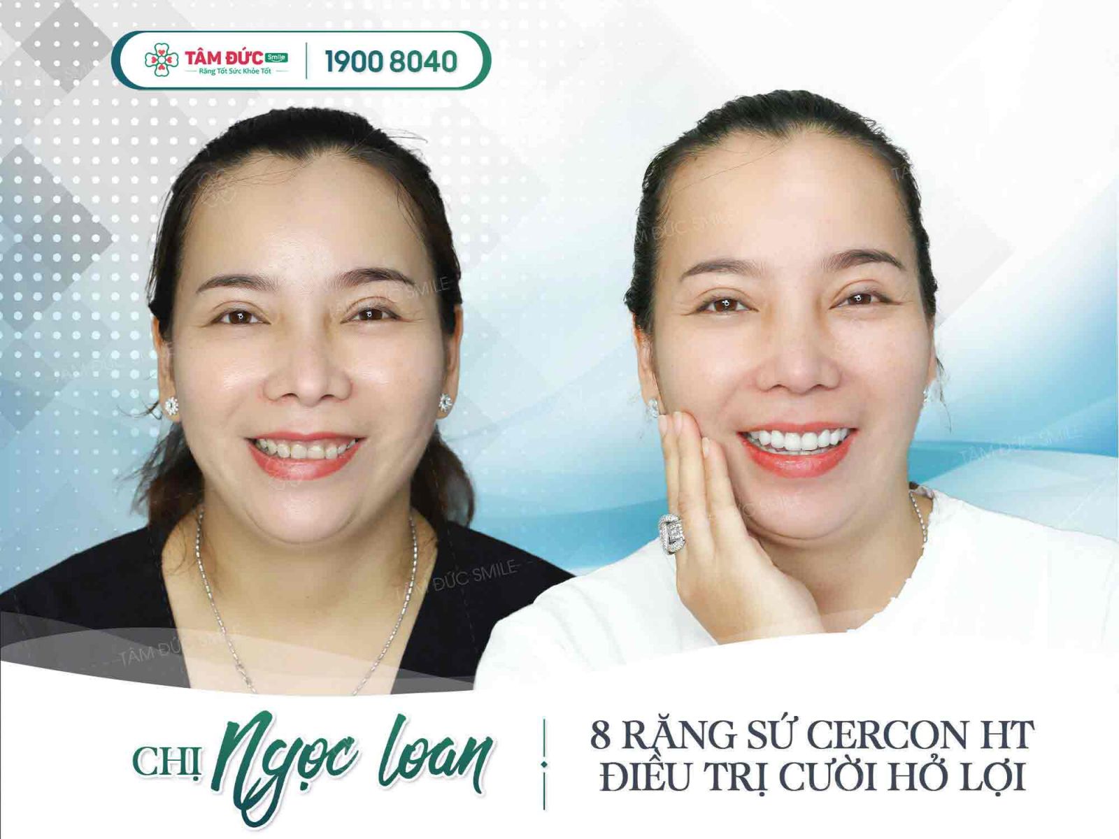 chị Loan sau khi điều trị cắt nạo chóp răng tại nha khoa Tâm Đức Smile