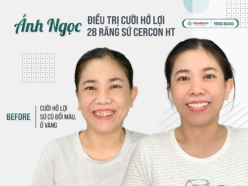 chị ánh ngọc điều trị cười hở lợi tại nha khoa tâm đức smile