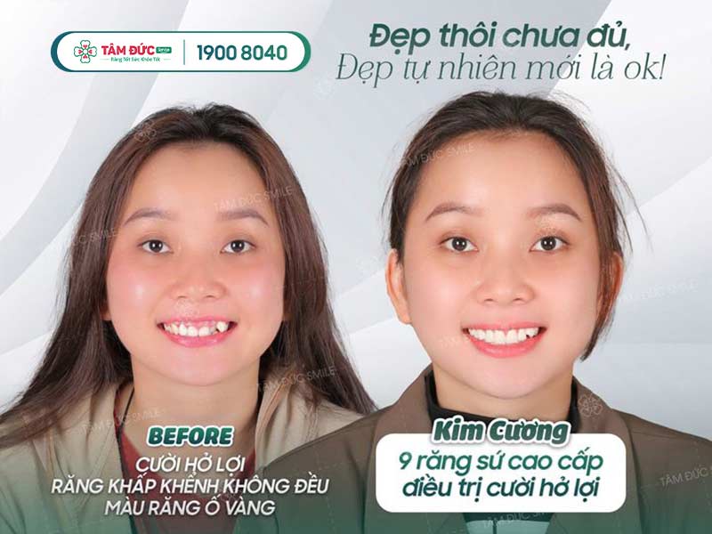 điều trị cười hở lợi ở nha khoa tâm đức smile