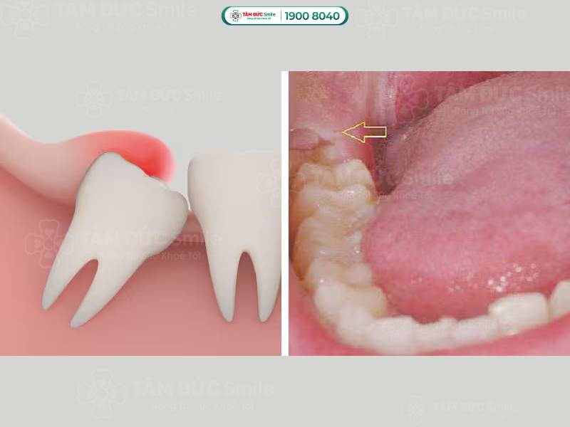 địa chỉ nha khoa nhổ răng khôn ở Tân Phú được khách hàng đánh giá cao