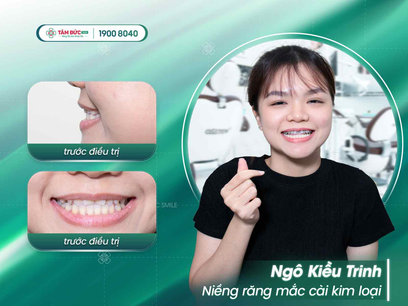 niềng răng mọc lệch tại nha khoa Tâm Đức Smile