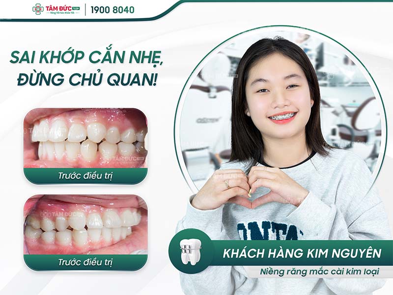 khách hàng niềng răng mắc cài tại nha khoa tâm đức smile