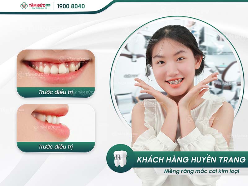 khách hàng niềng răng mắc cài tại nha khoa tâm đức smile