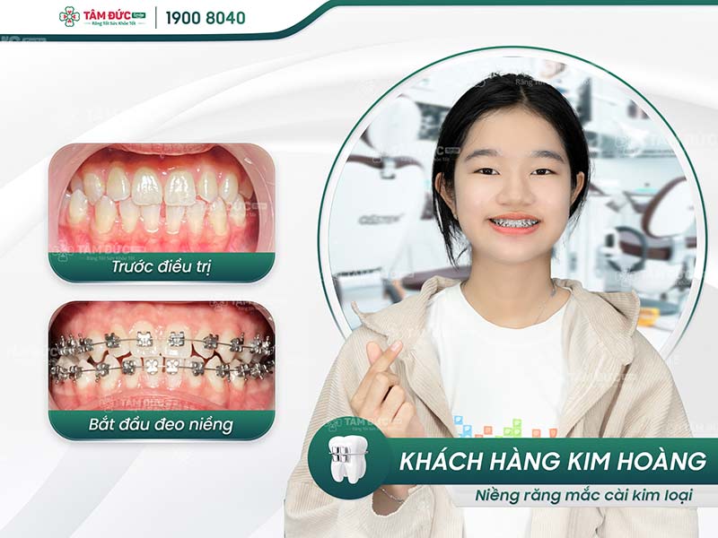 khách hàng niềng răng mắc cài tại nha khoa tâm đức smile