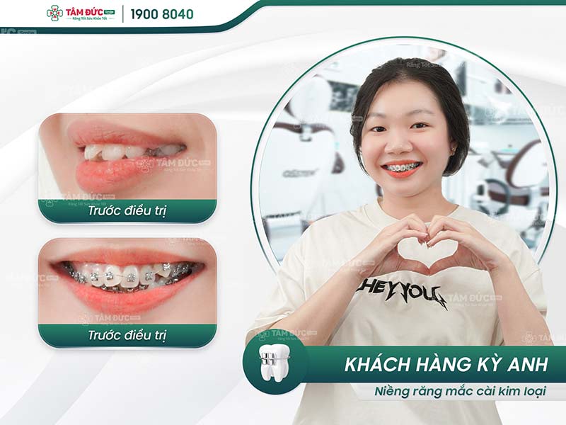 khách hàng niềng răng mắc cài tại nha khoa tâm đức smile