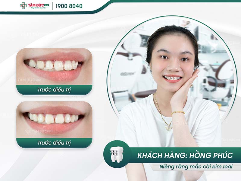 khách hàng niềng răng mắc cài tại nha khoa tâm đức smile