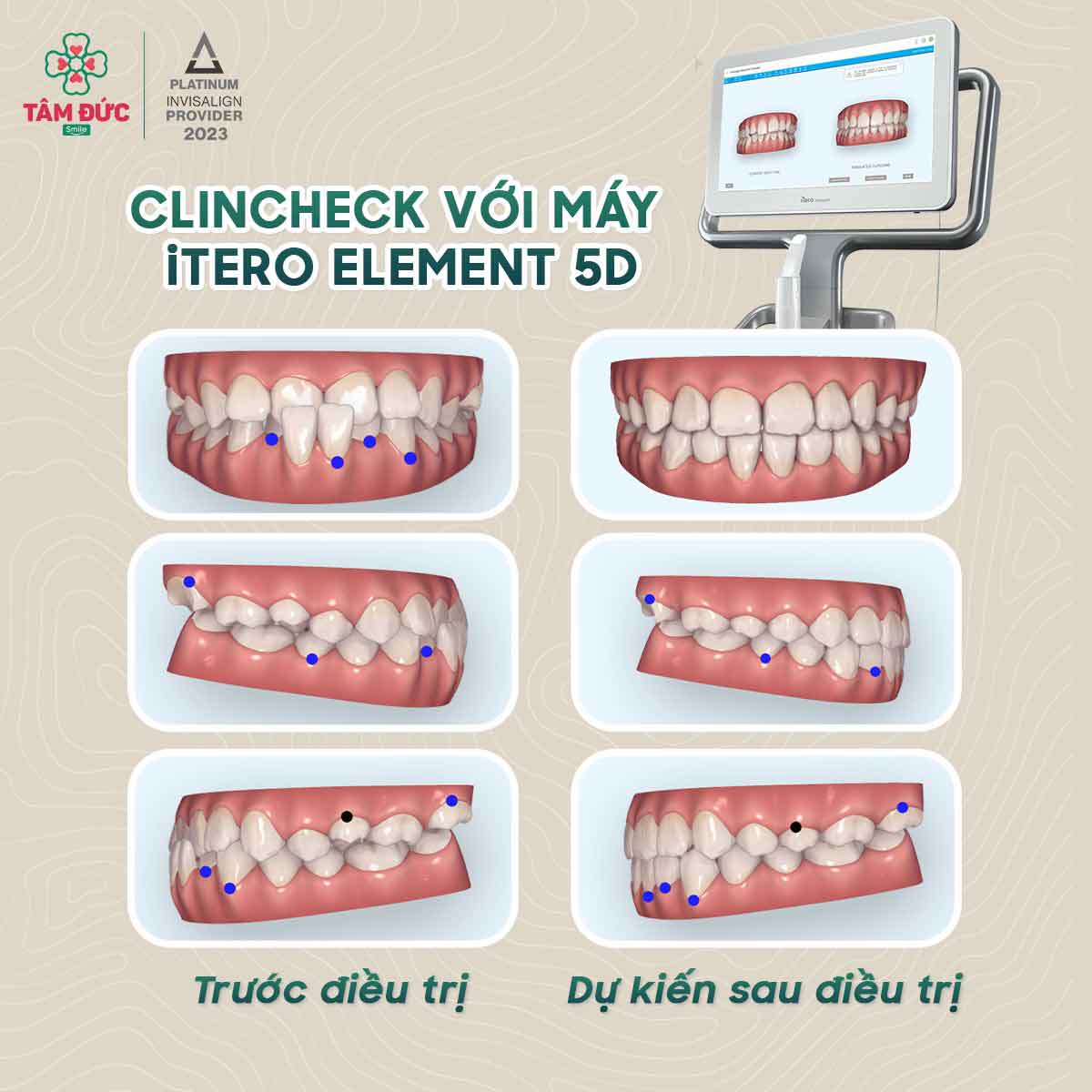 phần mềm clincheck biết trước kết quả niềng răng