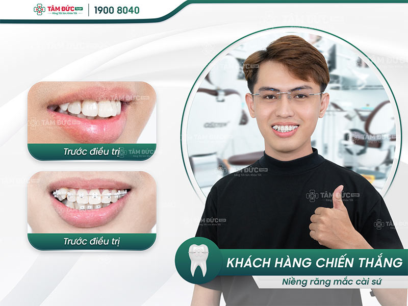 khách hàng niềng răng mắc cài tại nha khoa tâm đức smile