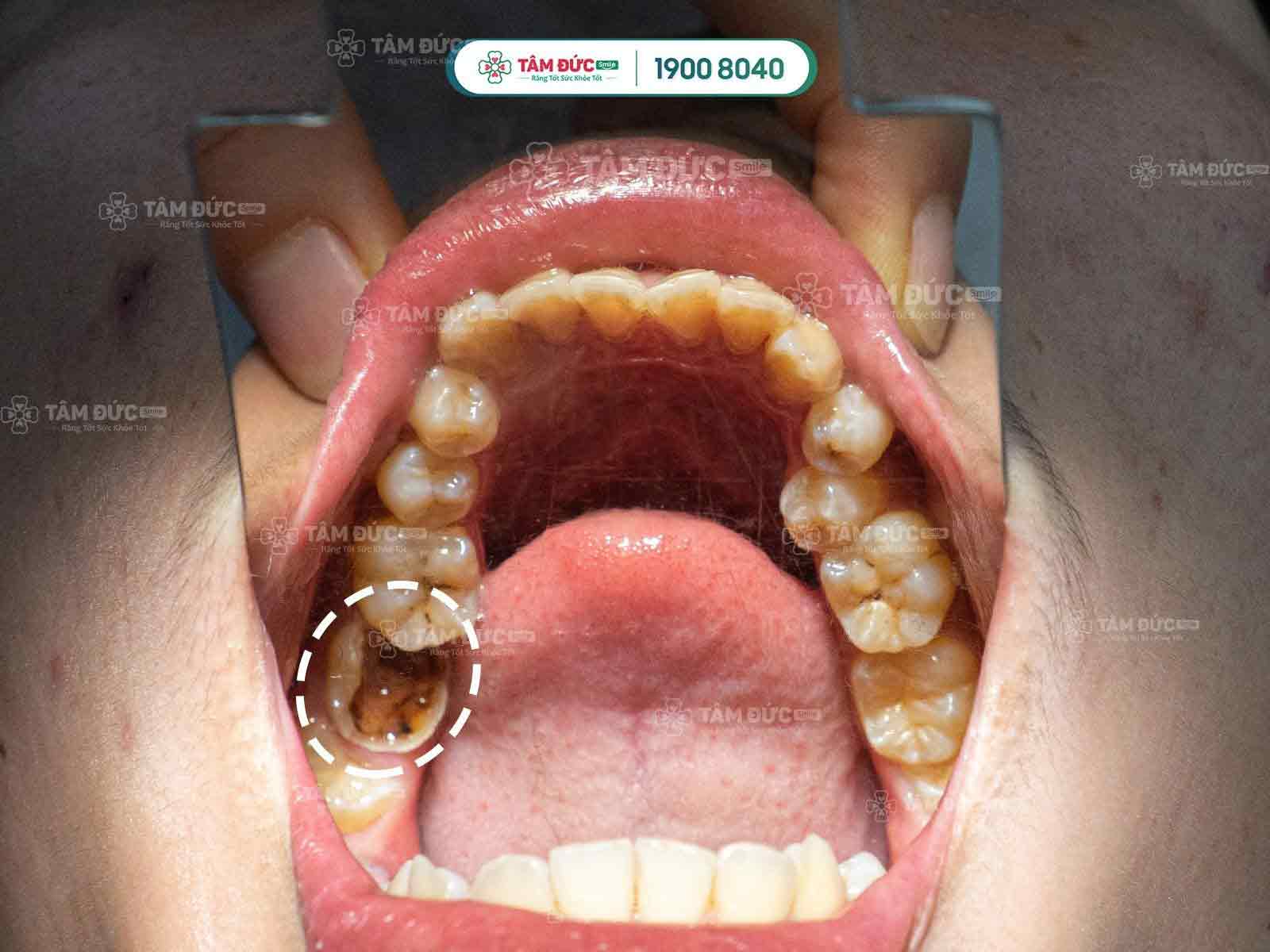 Tâm Đức Smile là địa chỉ trám răng thẩm mỹ uy tín toàn quốc