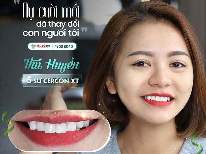 địa chỉ trám răng thẩm mỹ tại nha khoa Tâm Đức Smile