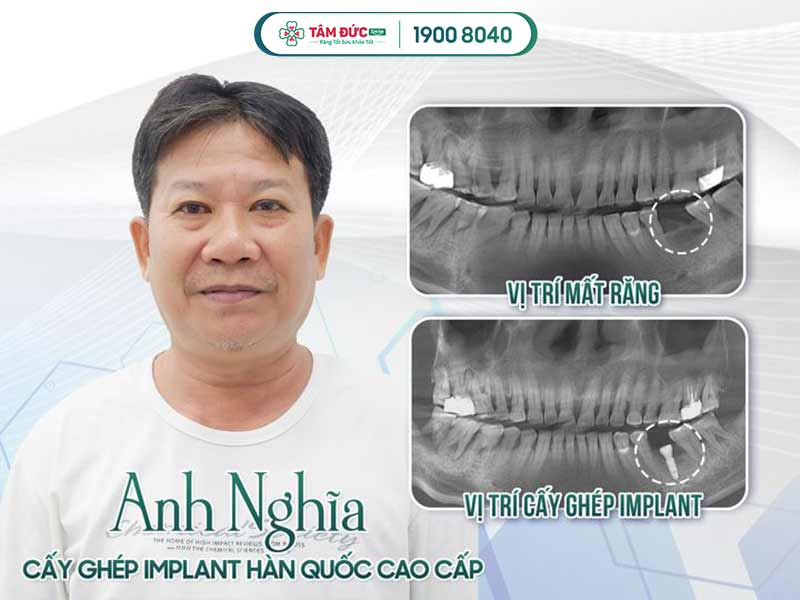 địa chỉ trồng răng implant uy tín tại đà nẵng