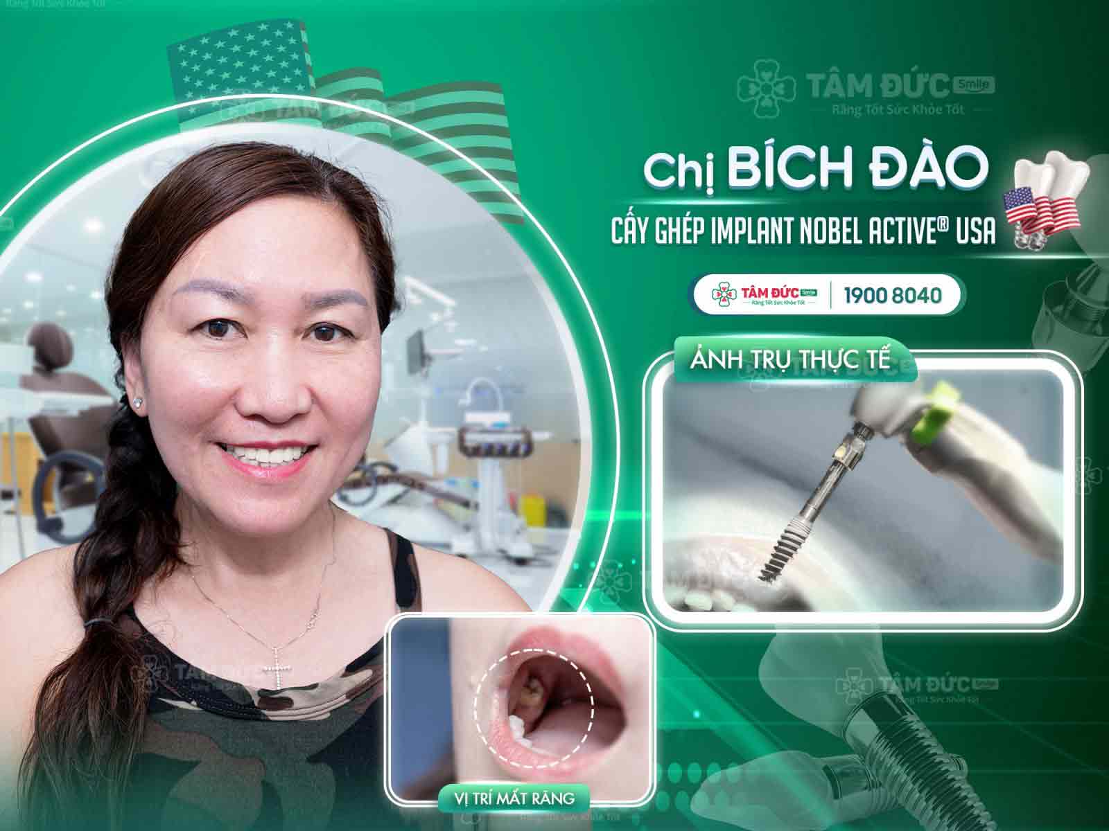 địa chỉ trồng răng implant uy tín tại Tây Ninh