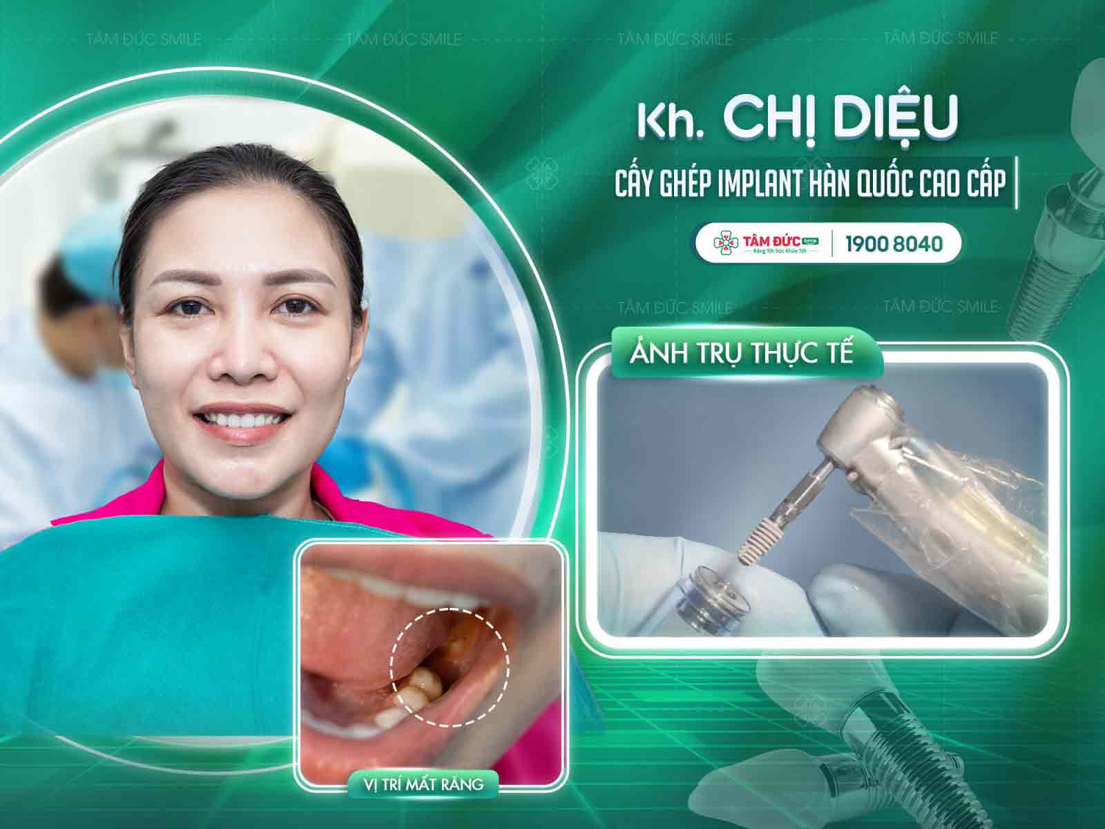 khách hàng trồng răng implant tại nha khoa Tâm Đức Smile