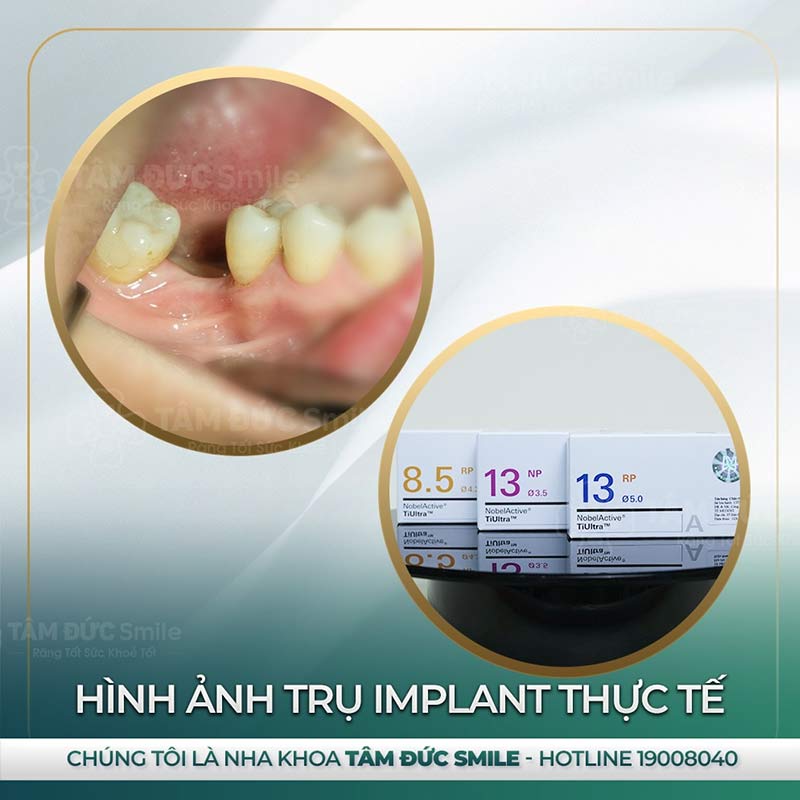 địa chỉ trồng răng Implant tại đà lạt