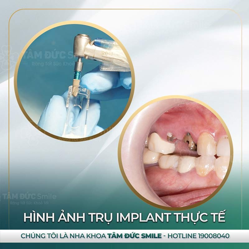 địa chỉ trồng răng Implant tại đà lạt