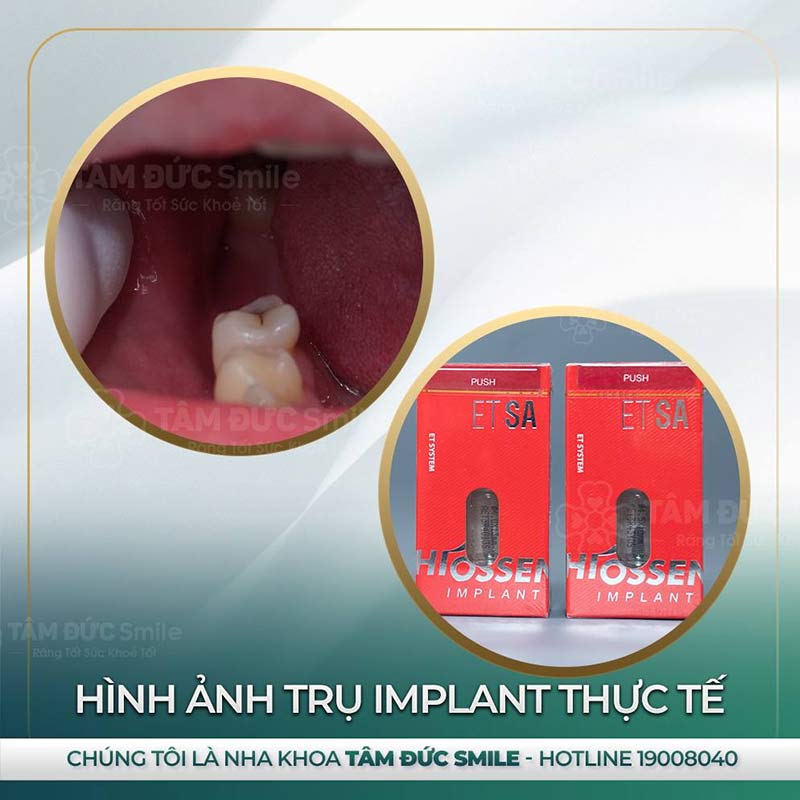 địa chỉ trồng răng Implant tại đà lạt