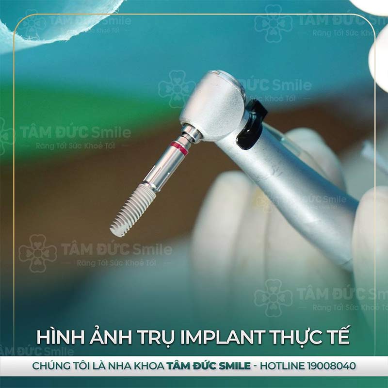 địa chỉ trồng răng Implant tại đà lạt