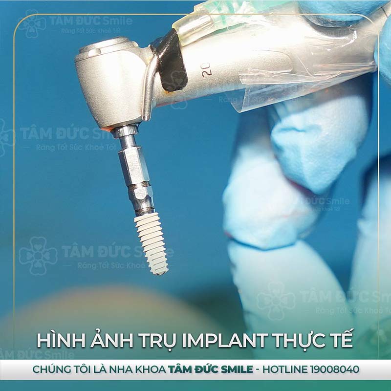 địa chỉ trồng răng Implant tại đà lạt