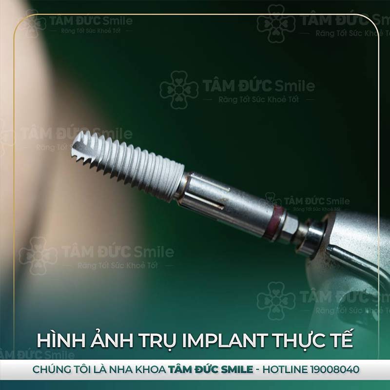 địa chỉ trồng răng Implant tại đà lạt