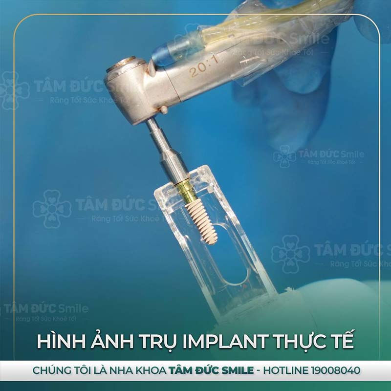 địa chỉ trồng răng Implant tại đà lạt