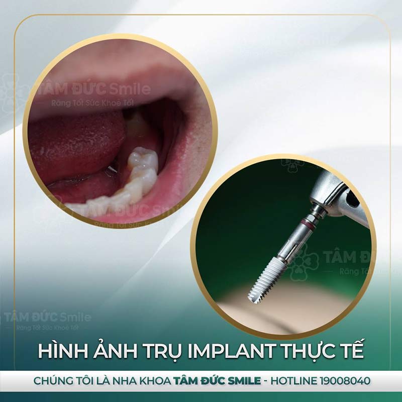 địa chỉ trồng răng Implant tại đà lạt