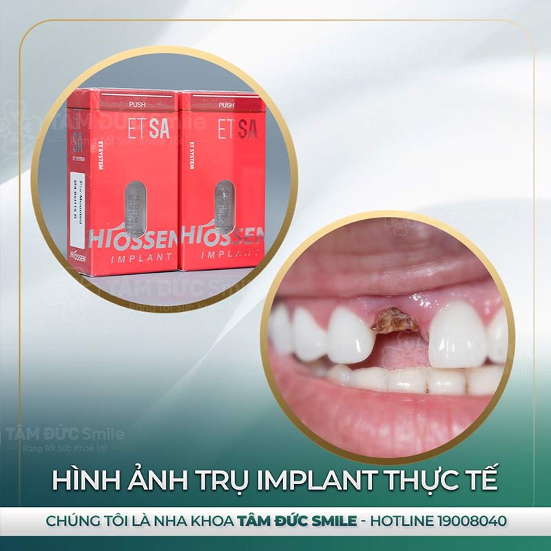 địa chỉ trồng răng Implant tại đà lạt