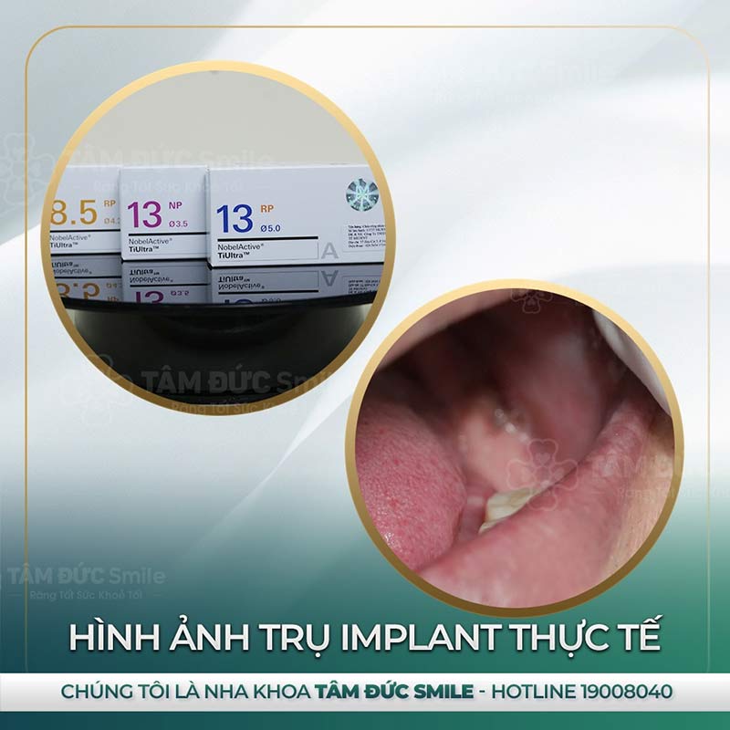 địa chỉ trồng răng Implant tại đà lạt