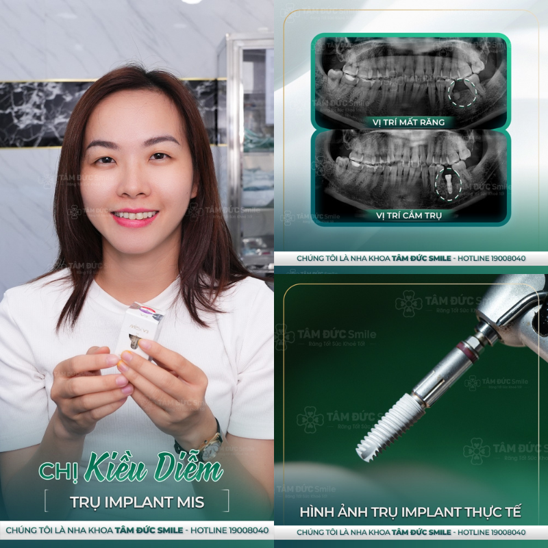 khách hàng trồng răng implant tại nha khoa Tâm Đức Smile