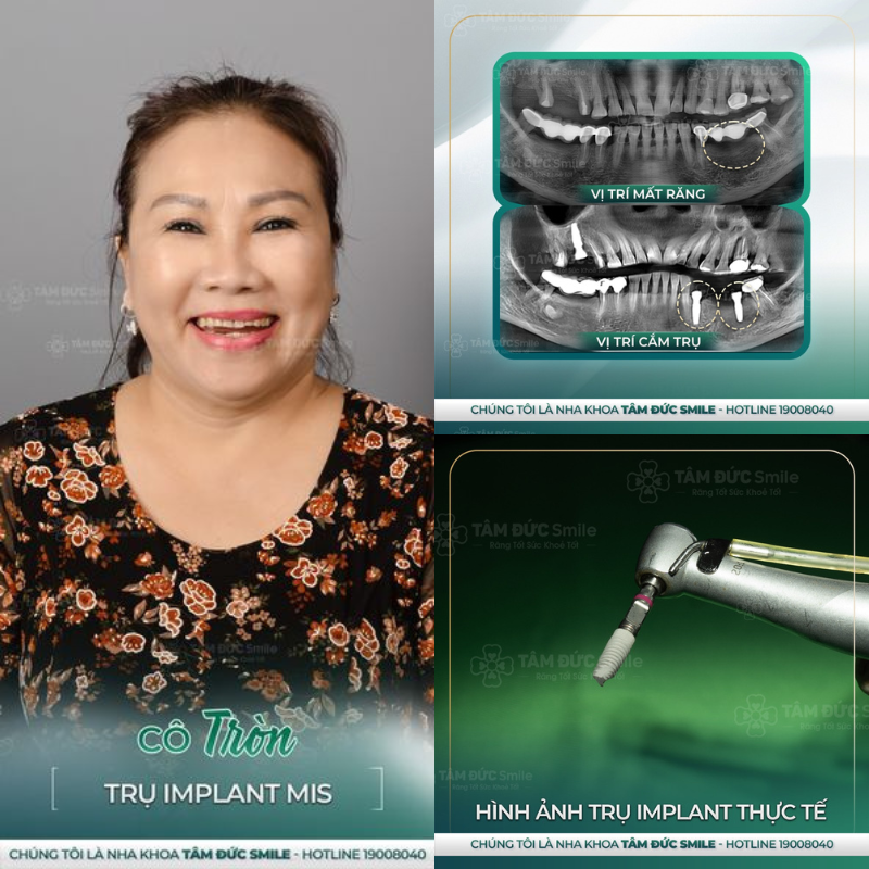 địa chỉ trồng răng implant uy tín tại Tây Ninh