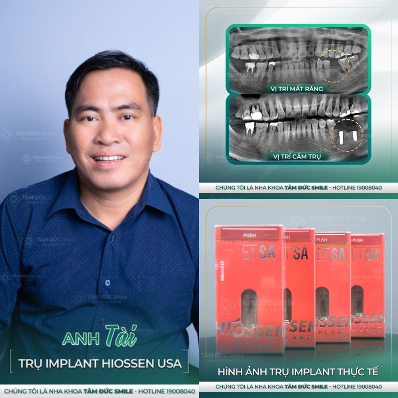 địa chỉ trồng răng implant uy tín tại Tây Ninh