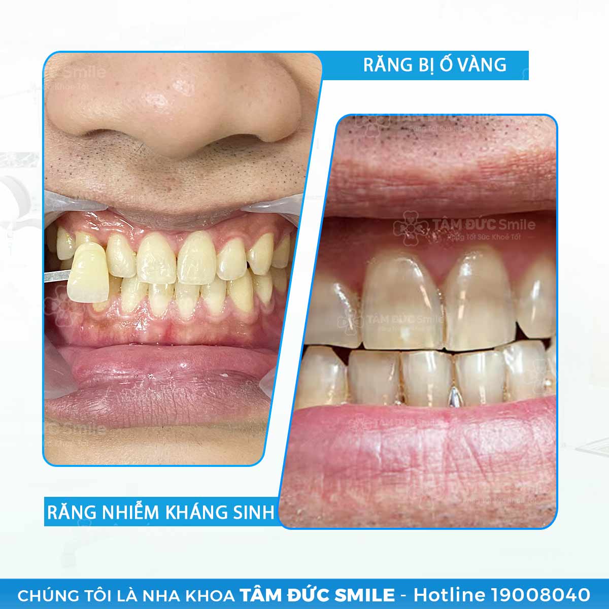 dịch vụ tẩy trắng răng tâm đức smile