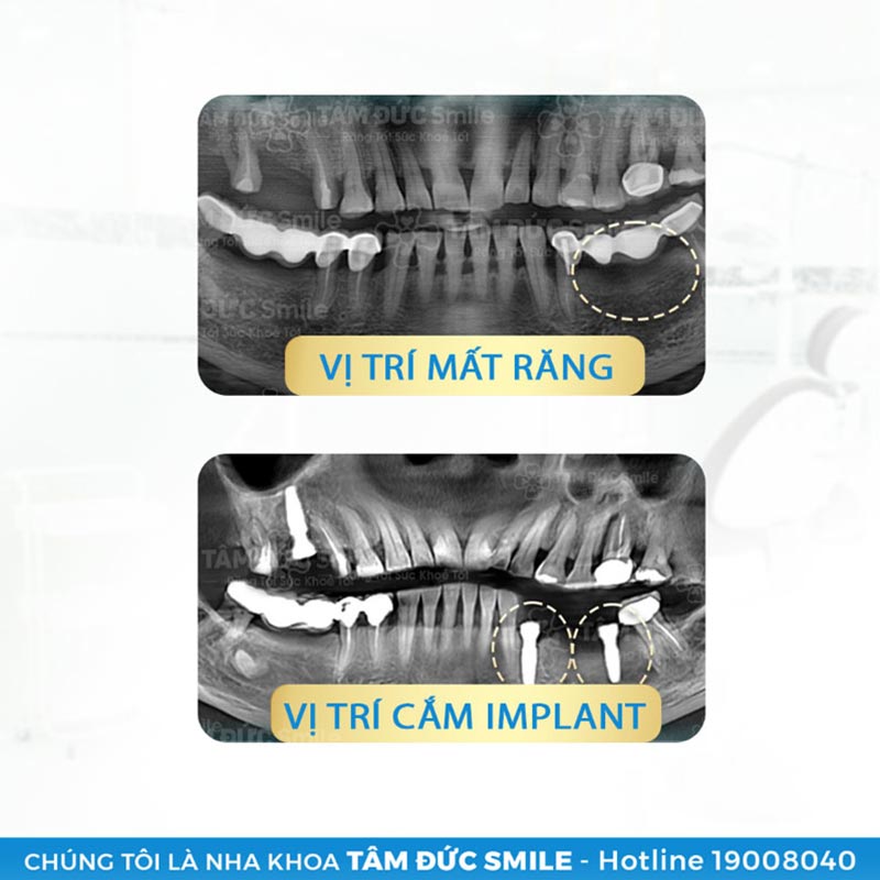 dịch vụ trồng răng implant tâm đức smile