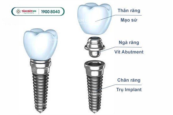 cấu tạo đầy đủ của một chiếc răng implant