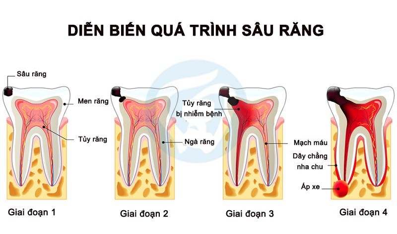 Quá trình sâu răng diễn ra như thế nào?