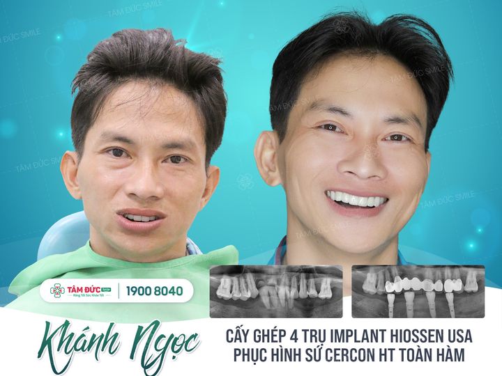 Anh Khánh Ngọc sau khi cấy ghép Implant All on 4 tại nha khoa Tâm Đức Smile