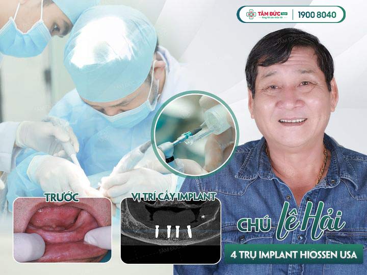 chú Hải đủ điều kiện cấy ghép Implant all on 4 an toàn