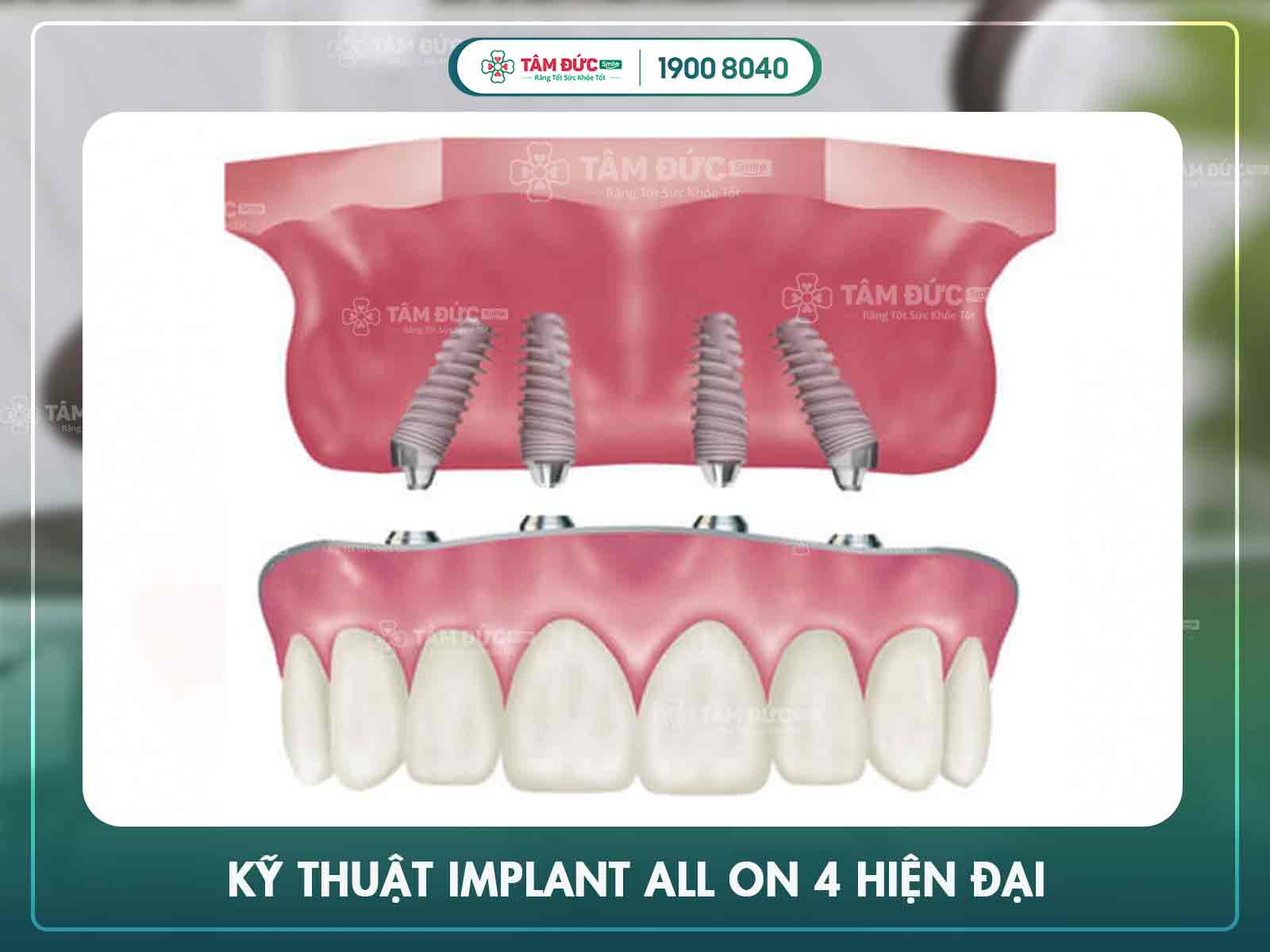 điều kiện cấy ghép Implant all on 4