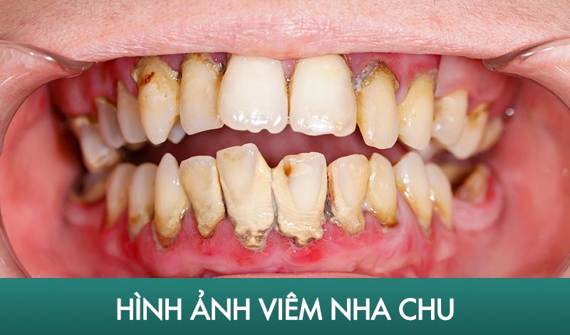 điều trị viêm nha chu có đau không