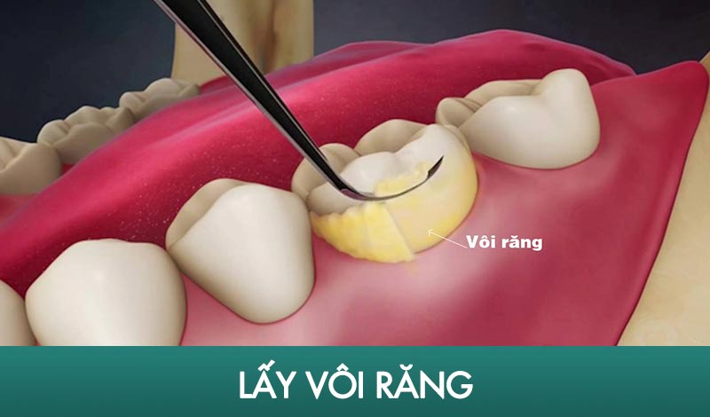 cạo vôi răng là cách điều trị viêm nha chu hiệu quả