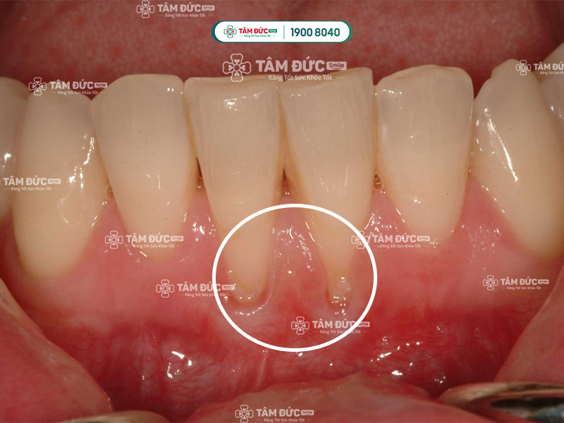 tụt nướu làm lộ ngà răng khiến cho răng nhạy cảm hơn