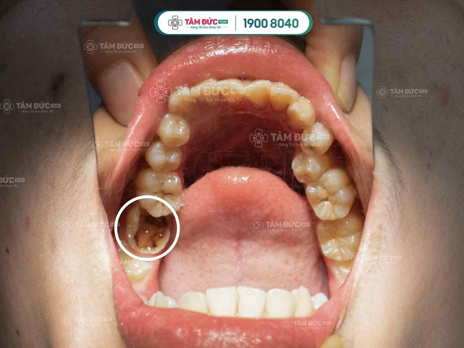 điều trị tuỷ răng tại nha khoa Tâm Đức Smile