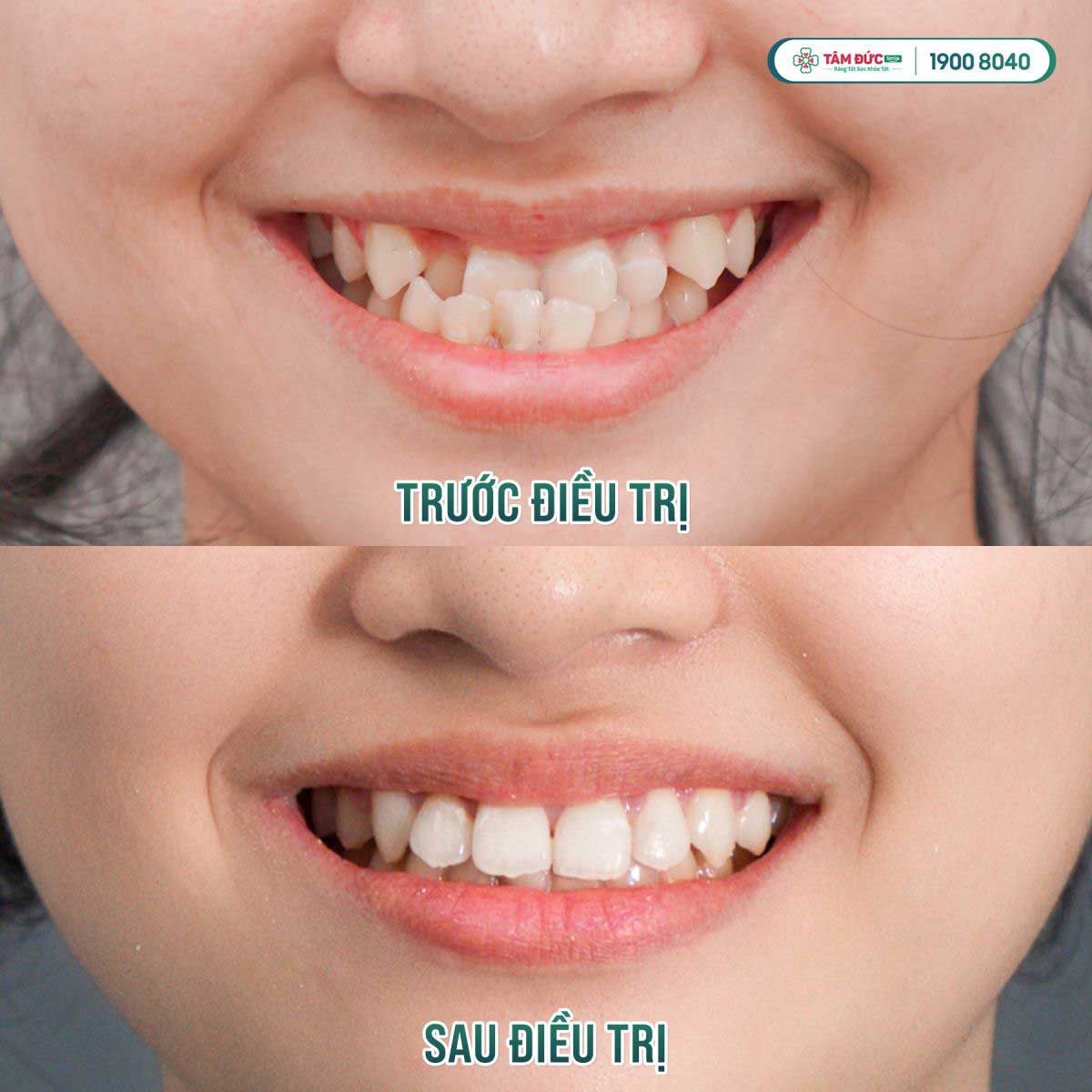 hình ảnh trước và sau khi niềng răng tại nha khoa Tâm Đức Smile